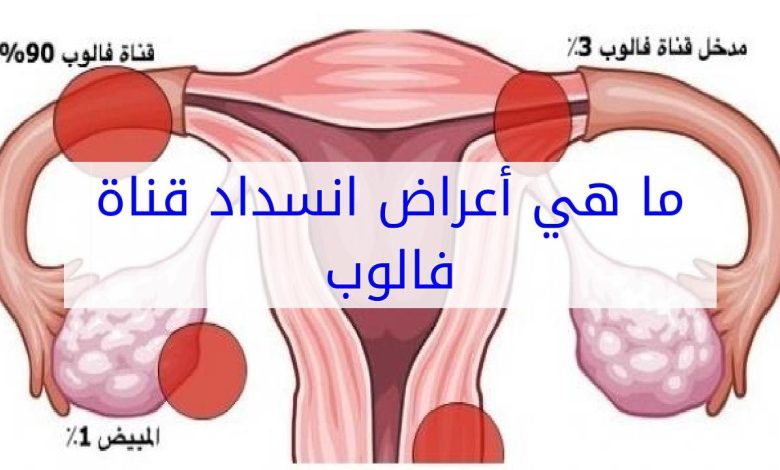 أعراض انسداد قنوات فالوب-الأسباب وإمكانية الحمل